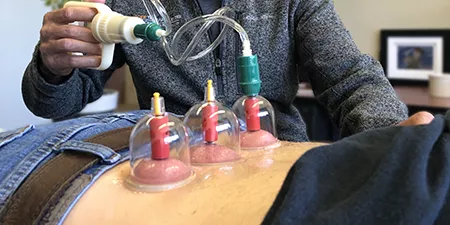 Cupping - Physical Therapy Treatment